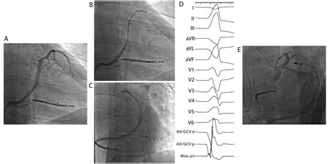 left ventricular summit arrhythmia diagram